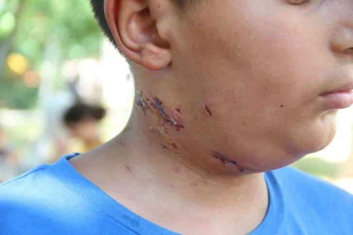 10 Yaşındaki Çocuk Köpek Saldırısına Uğradı 