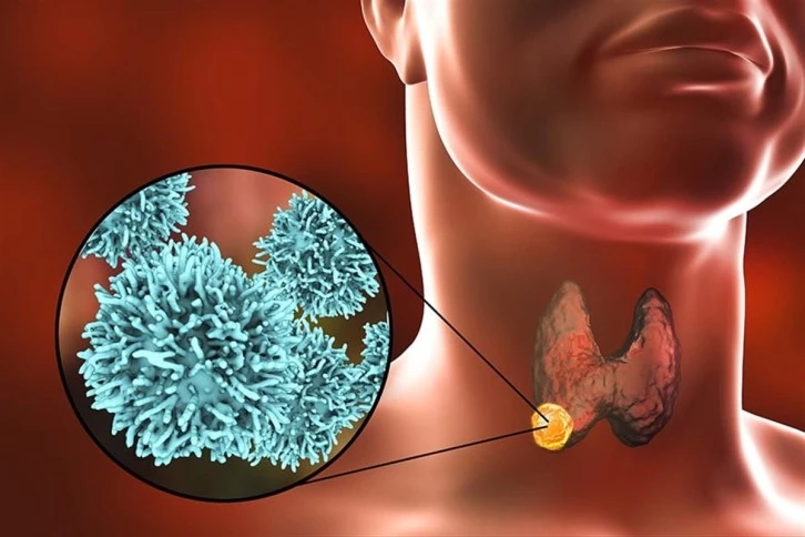 Tiroid Kanserleri Kadınlarda 3 Kat Fazla Görülüyor