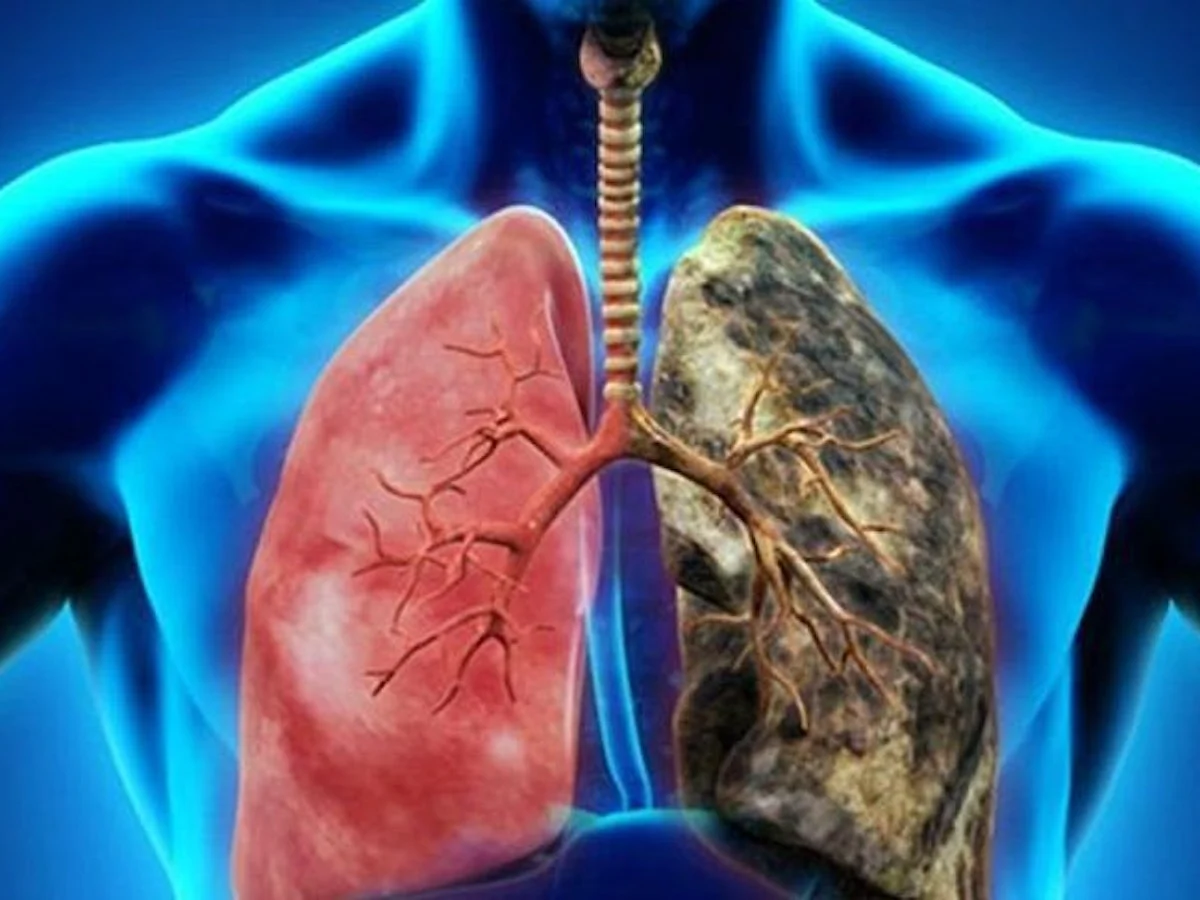 Akciğer Kanserinin Yüzde 80'i Sigaradan 